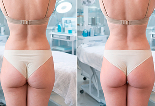 Результаты Обертывания