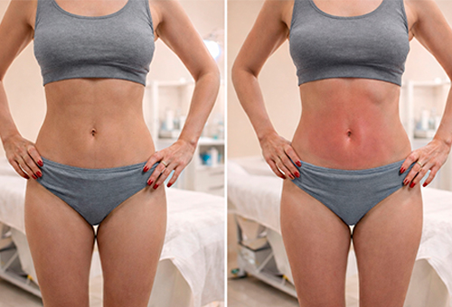 Результаты Обертывания