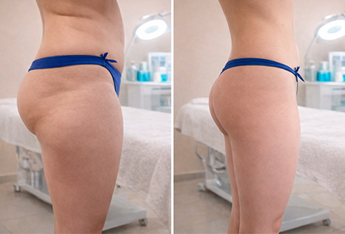 Результаты Обертывания