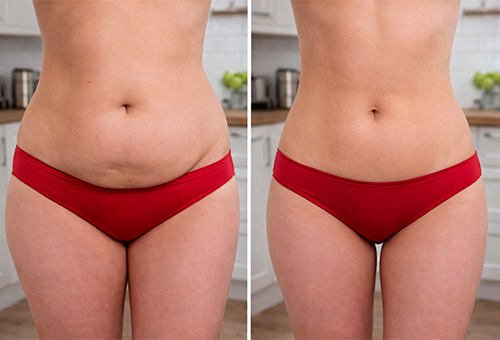 Результаты RF-лифтинга в клинике