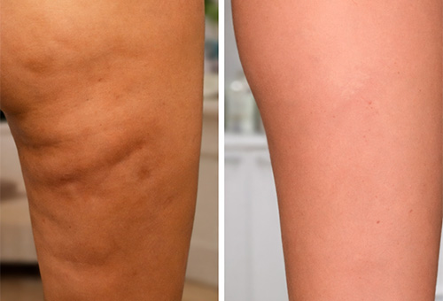 Результаты Обертывания