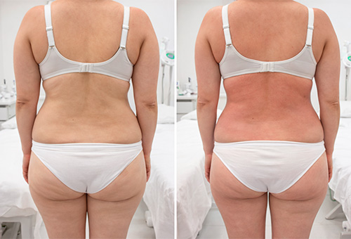 Результаты RF-лифтинга в клинике