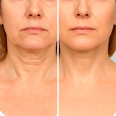 Результаты СМАС-лифтинга шеи Ultraformer MPT