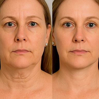 Результаты СМАС-лифтинга шеи Ultraformer MPT